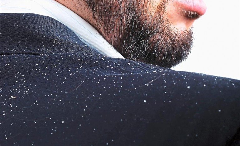 How to get rid of dandruff in one wash (5)