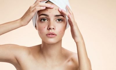 How to Get Rid of Acne Scars